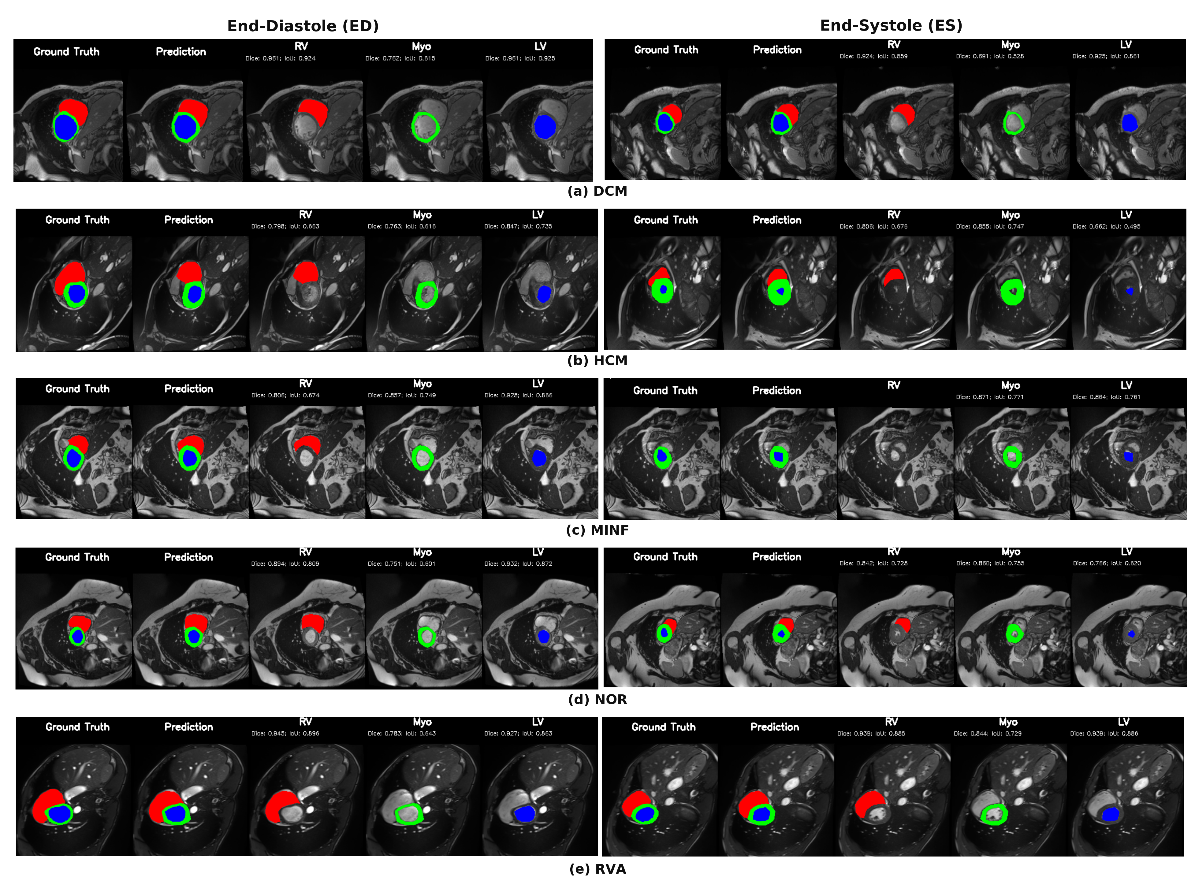 ACDC segmentation across cardiomyopathy classes