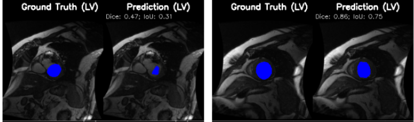 Sunnybrook segmentation